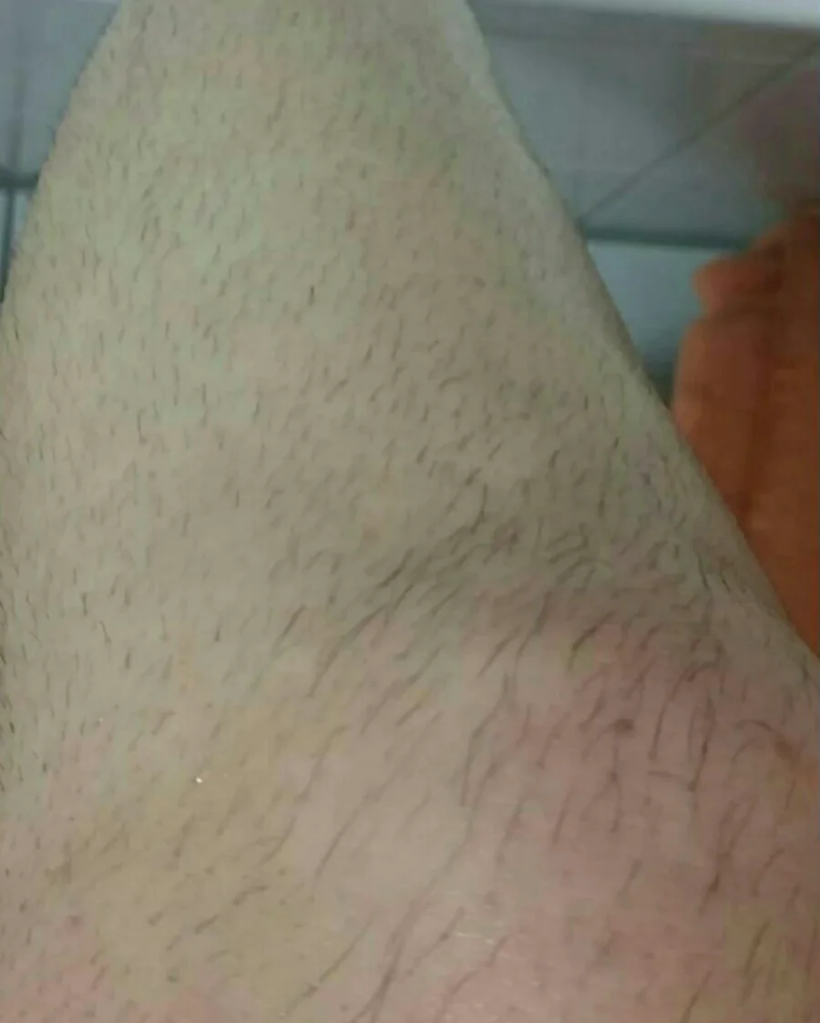 Bein vor der Laser-Haarentfernung, unbehandelt