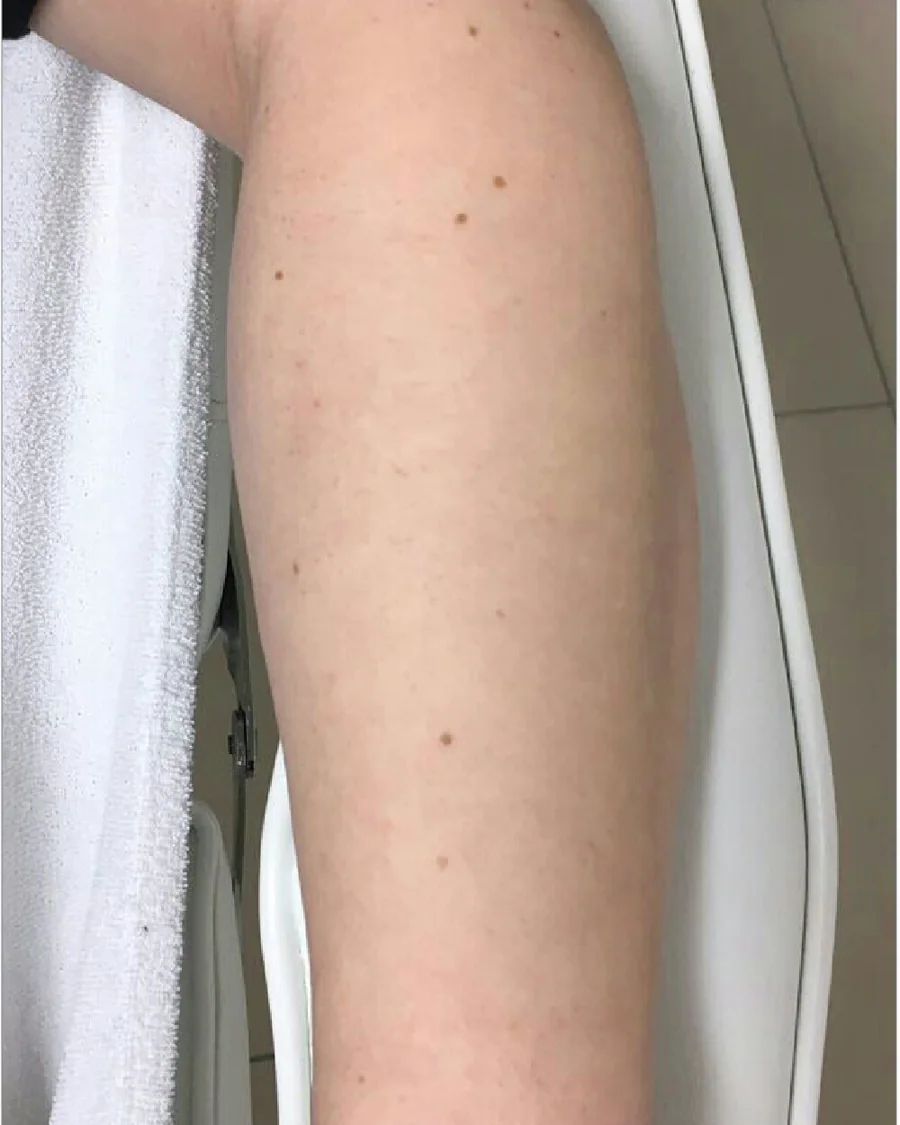 Arm nach acht Sitzungen Laser-Haarentfernung mit dem Alexandrit-Laser